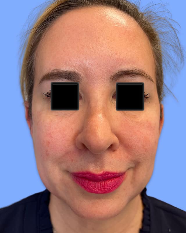 Facial Rejuvenation Fillers  Before & After Image