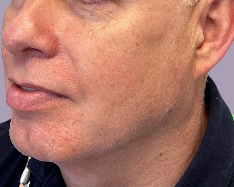 Jawline Filler Before & After Image