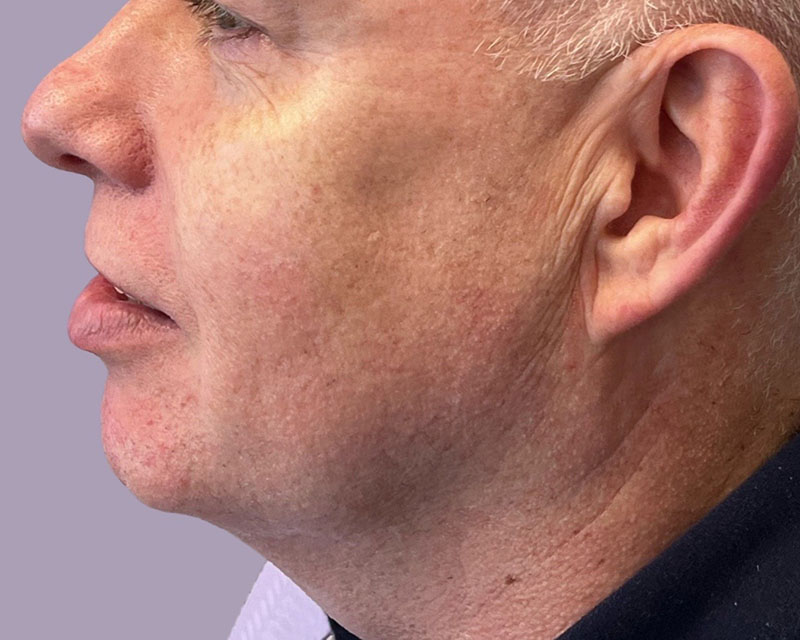 Jawline Filler Before & After Image