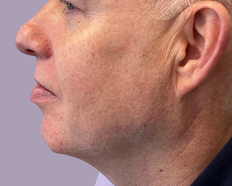 Jawline Filler Before & After Image