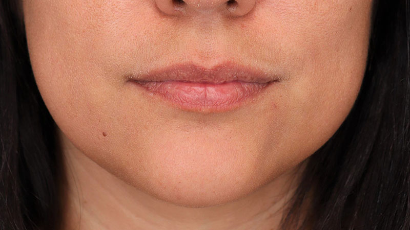 Lip Fillers Before & After Image