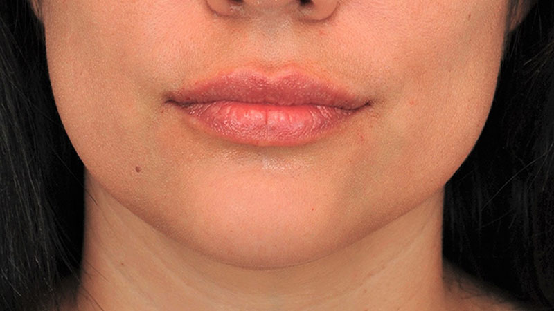 Lip Fillers Before & After Image