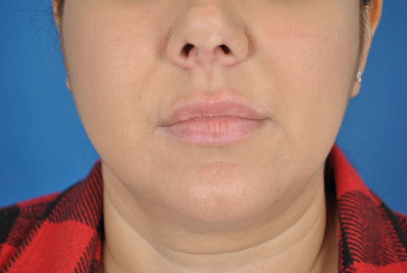 Lip Fillers Before & After Image