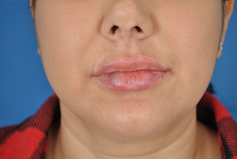 Lip Fillers Before & After Image