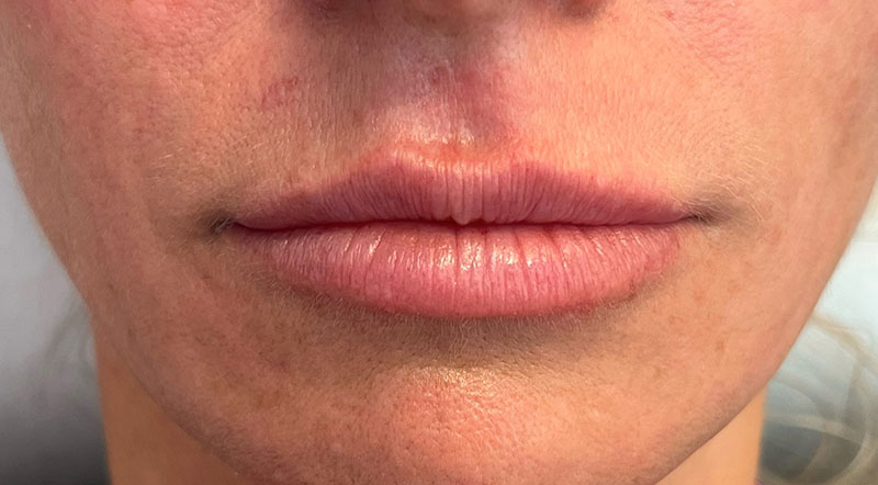 Lip Fillers Before & After Image