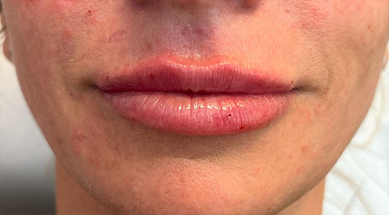 Lip Fillers Before & After Image