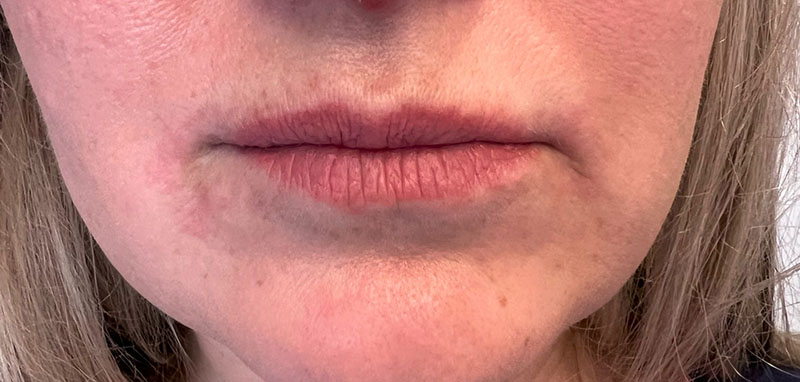 Lip Fillers Before & After Image