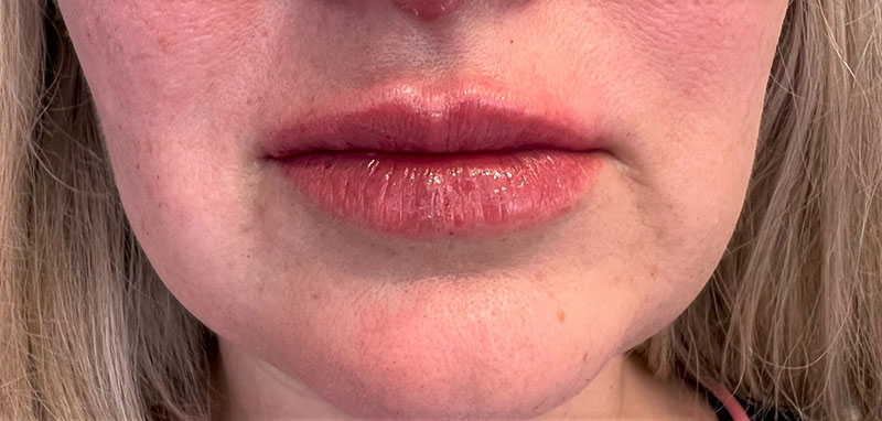 Lip Fillers Before & After Image