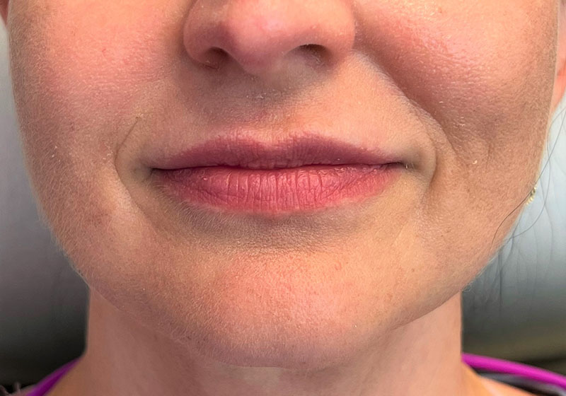 Lip Fillers Before & After Image