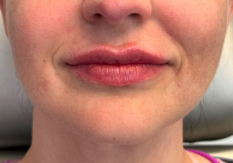 Lip Fillers Before & After Image