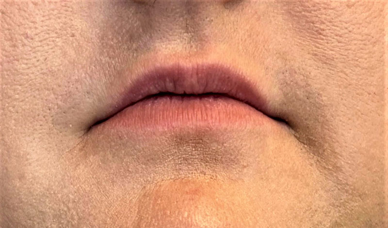 Lip Fillers Before & After Image