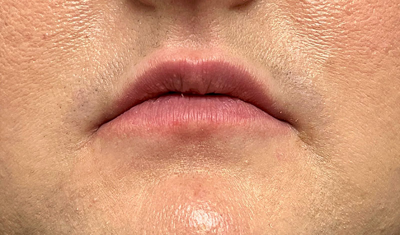 Lip Fillers Before & After Image