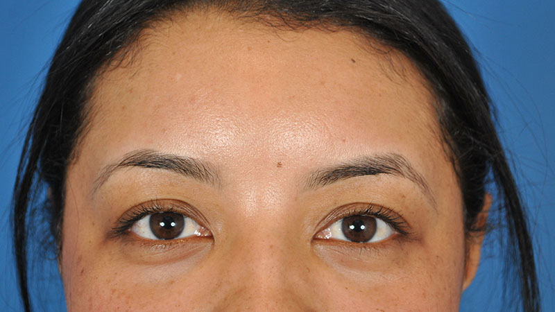 Tear Trough Filler Before & After Image