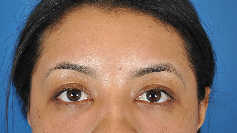 Tear Trough Filler Before & After Image