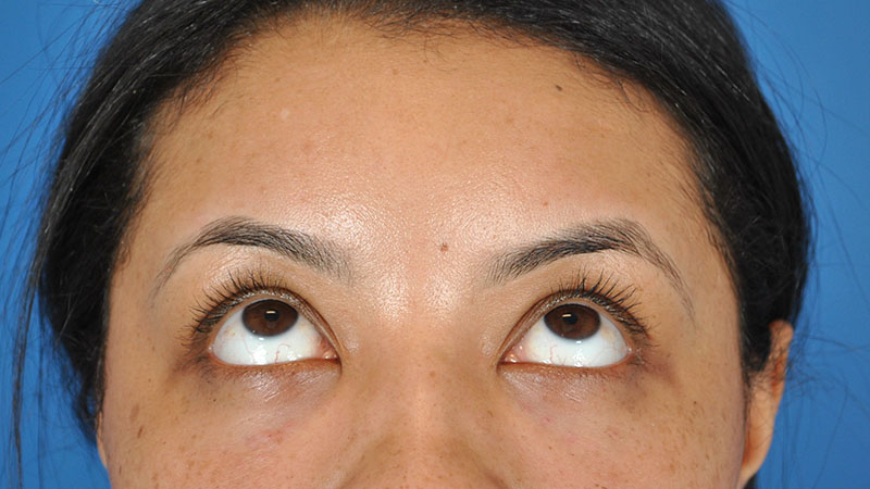 Tear Trough Filler Before & After Image