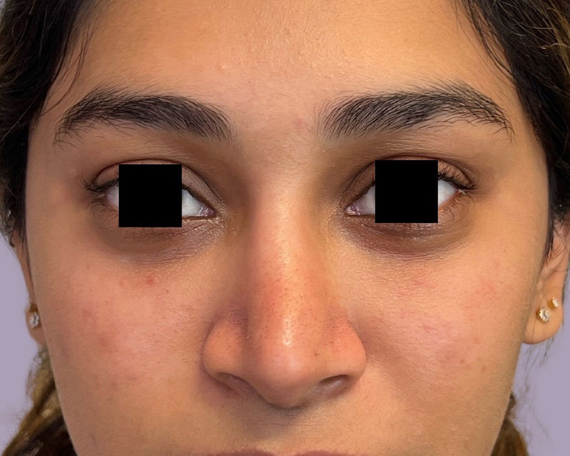 Tear Trough Filler Before & After Image