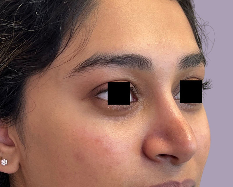 Tear Trough Filler Before & After Image