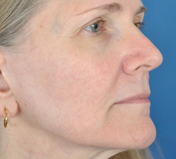 DermaV Laser Before & After Image