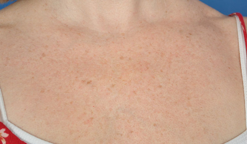 DermaV Laser Before & After Image