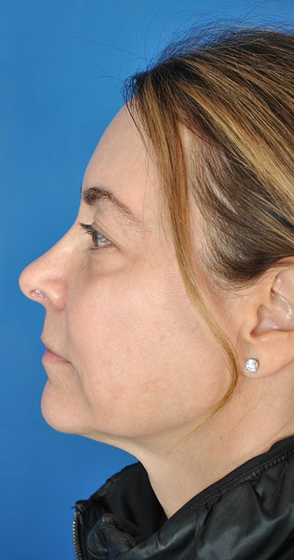 Hollywood Spectra Laser Before & After Image