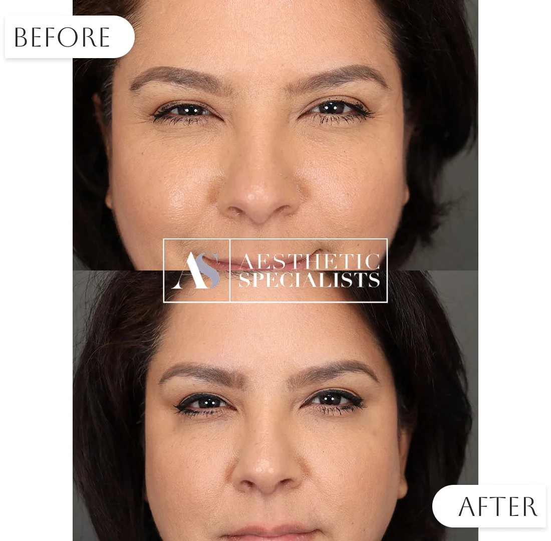 Botox before and after wrinkle reduction results | Medical Spa | Bellaire, TX | Aesthetic Specialists of Houston