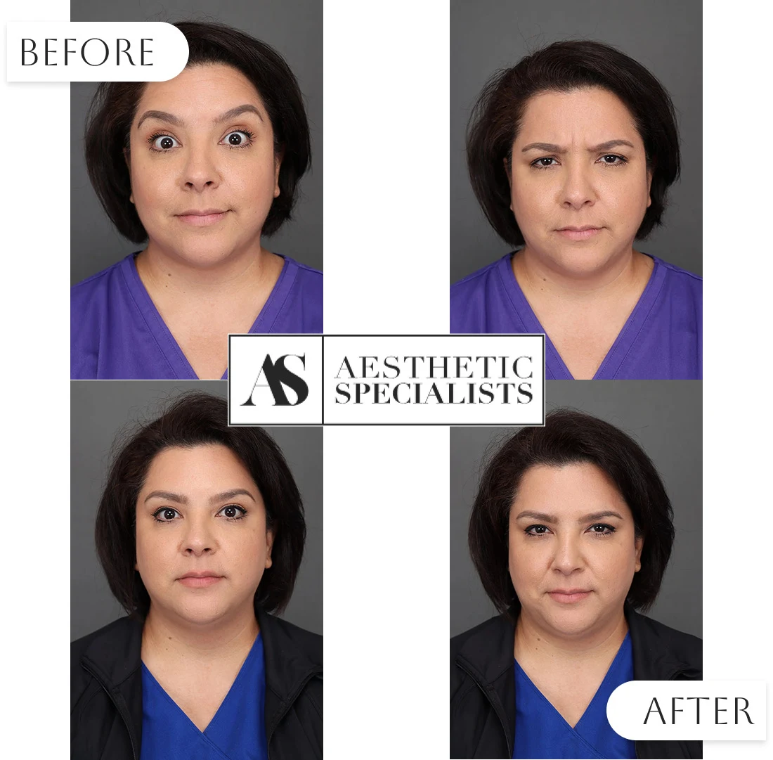 Before and after Botox treatment results | Medical Spa | Bellaire, TX | Aesthetic Specialists of Houston