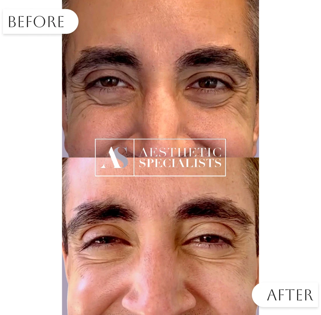 Before and after Botox facial smoothing results | Medical Spa | Bellaire, TX | Aesthetic Specialists of Houston