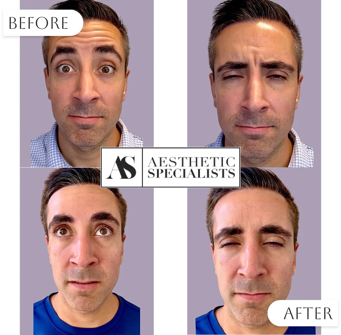 Botox treatment before and after improved fine lines | Medical Spa | Bellaire, TX | Aesthetic Specialists of Houston