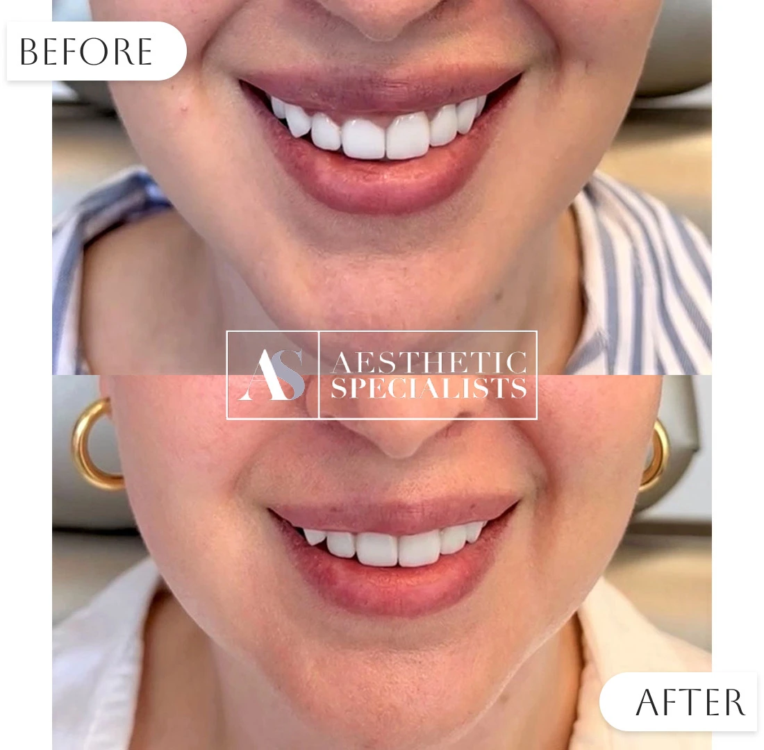 Before and after Botox cosmetic injections results | Medical Spa | Bellaire, TX | Aesthetic Specialists of Houston