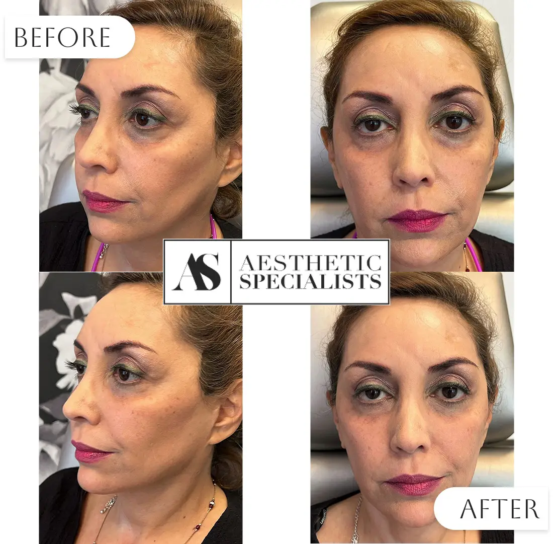 Before and after facial rejuvenation treatment on patient | Medical Spa | Bellaire, TX | Aesthetic Specialists of Houston