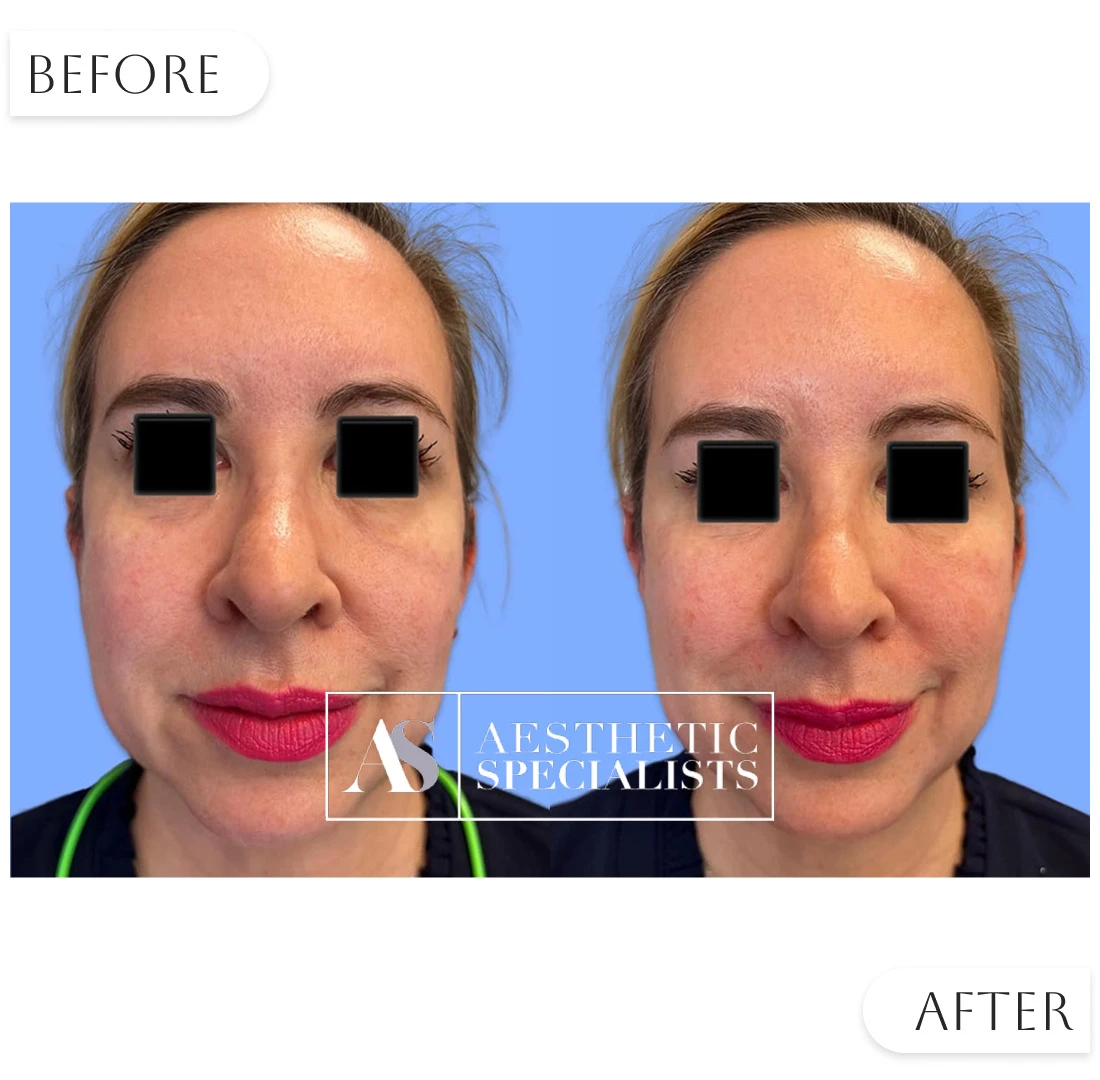 Before and after facial rejuvenation treatment results | Medical Spa | Bellaire, TX | Aesthetic Specialists of Houston
