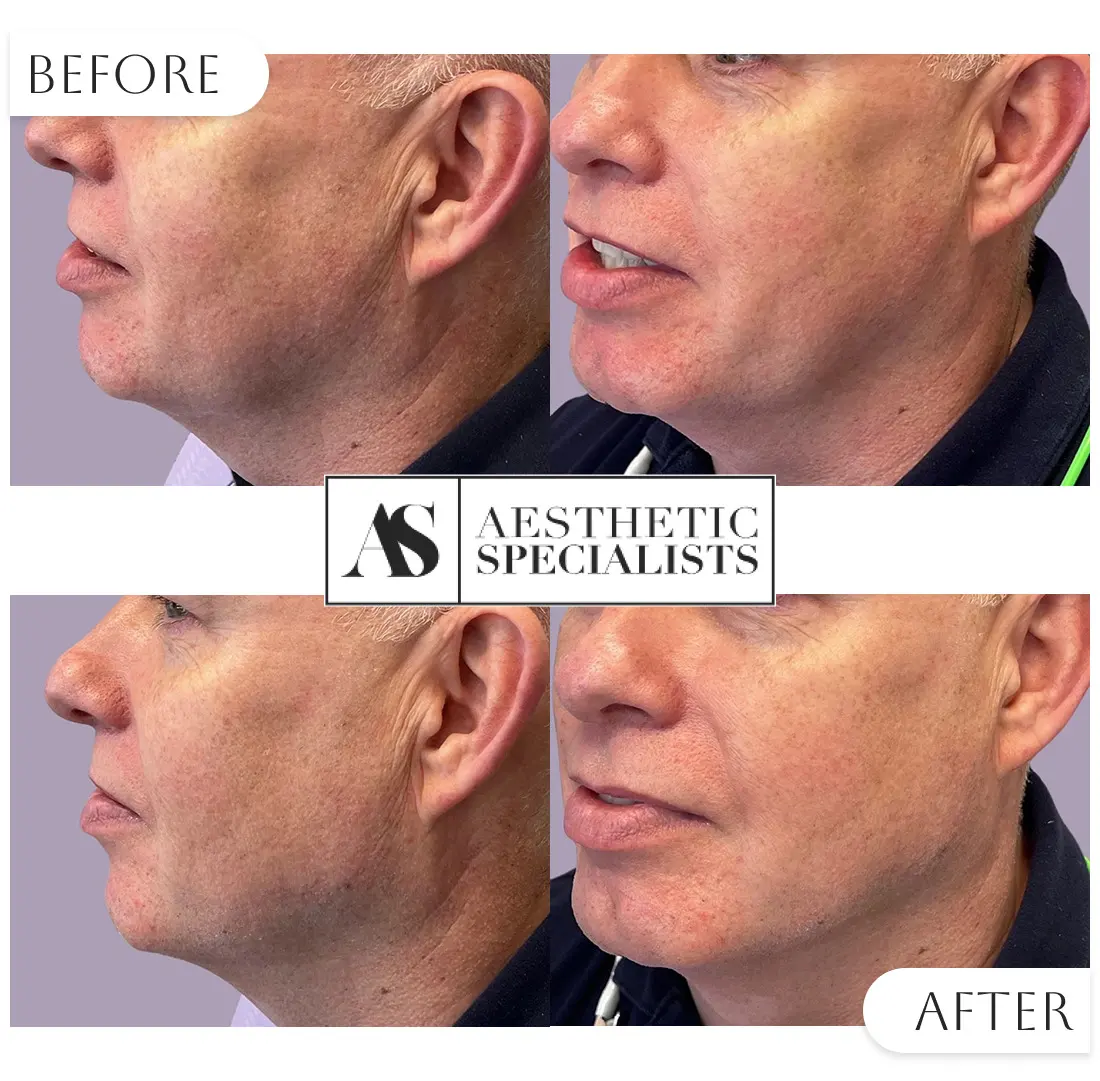 Before and after Jwaline skin treatment results | Medical Spa | Bellaire, TX | Aesthetic Specialists of Houston