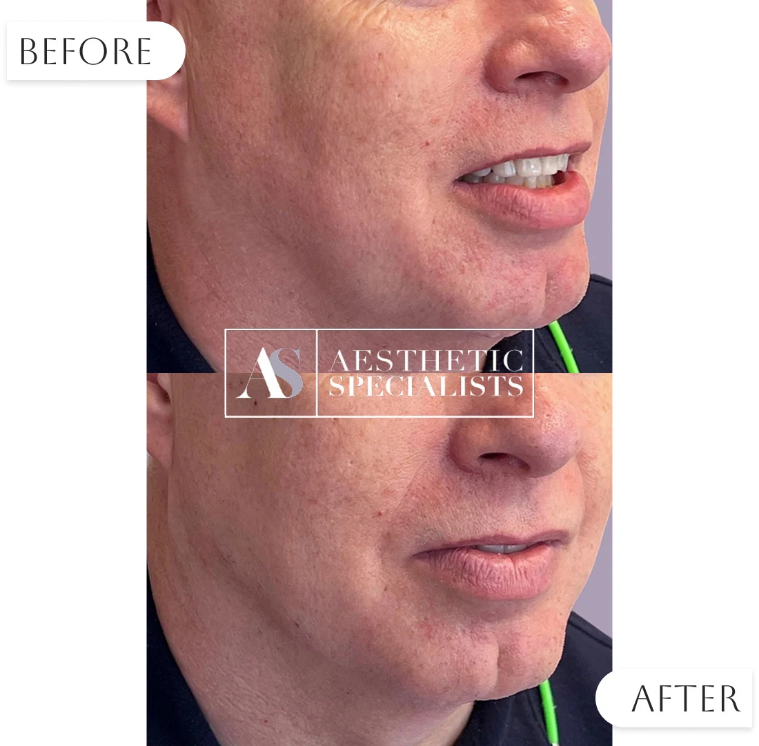 Before and after results from Jwaline treatment session | Medical Spa | Bellaire, TX | Aesthetic Specialists of Houston