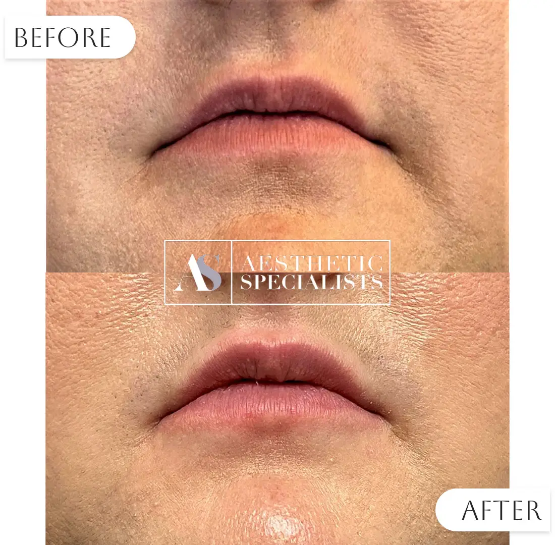 Before and after lip filler subtle enhancement results | Medical Spa | Bellaire, TX | Aesthetic Specialists of Houston