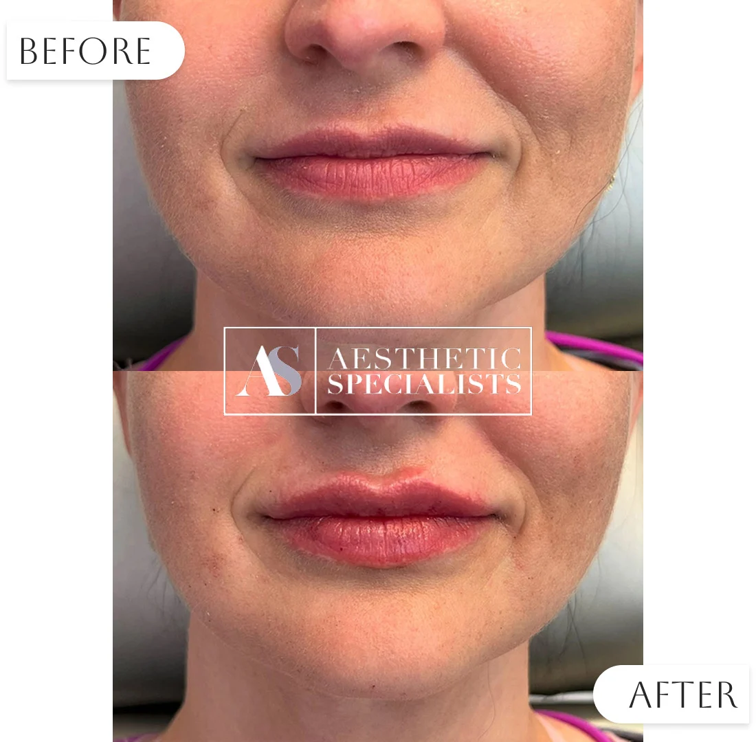 Lip enhancement before and after fuller lips results | Medical Spa | Bellaire, TX | Aesthetic Specialists of Houston