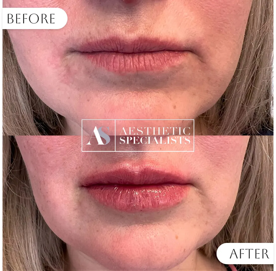 Lip filler before and after patient transformation | Medical Spa | Bellaire, TX | Aesthetic Specialists of Houston