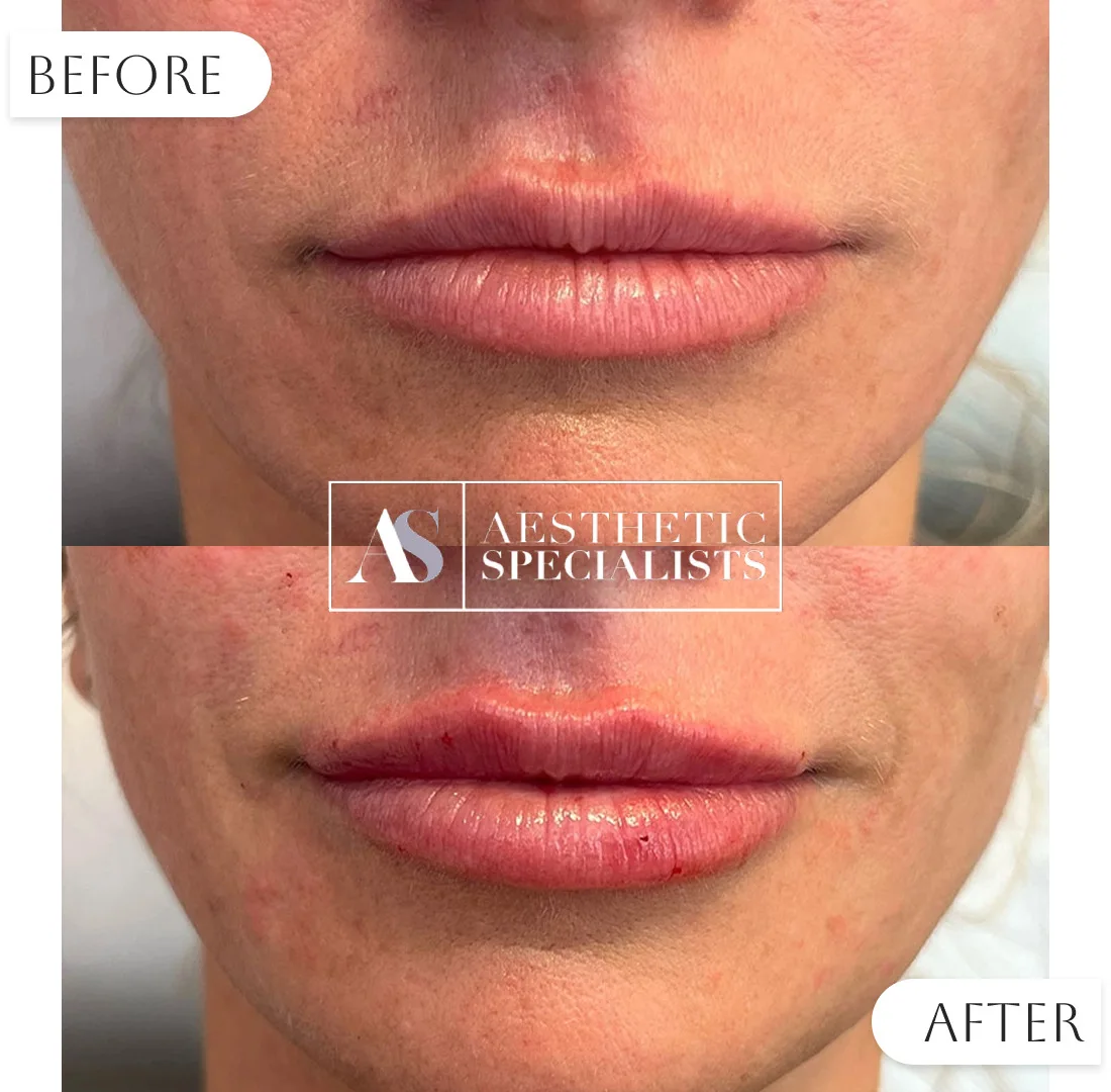 Before & after lip volume improvement with filler | Medical Spa | Bellaire, TX | Aesthetic Specialists of Houston