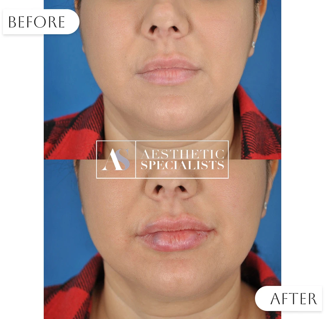 Lip filler before and after natural-looking results | Medical Spa | Bellaire, TX | Aesthetic Specialists of Houston