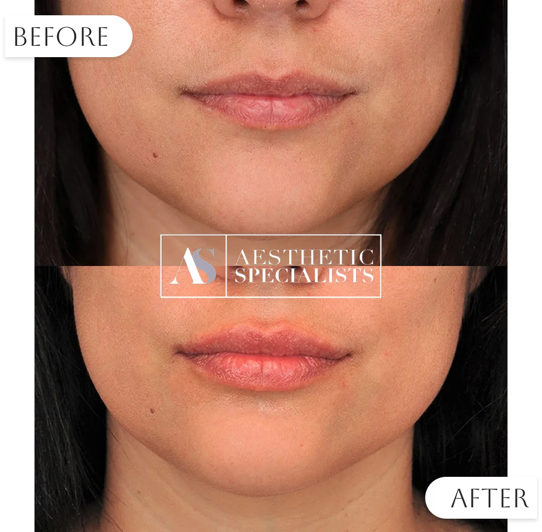 Before and after lip augmentation with filler | Medical Spa | Bellaire, TX | Aesthetic Specialists of Houston