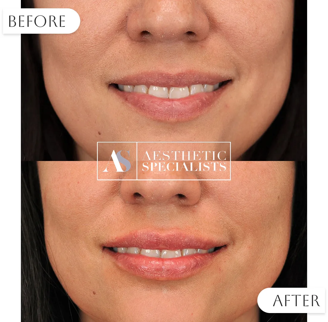Lip filler before and after patient transformation | Medical Spa | Bellaire, TX | Aesthetic Specialists of Houston