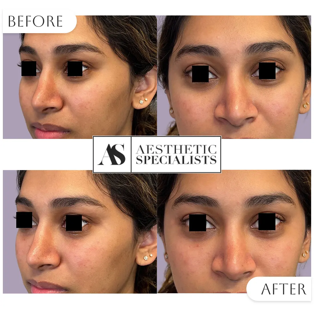 Before and after tear trough filler for refreshed under eyes | Medical Spa | Bellaire, TX | Aesthetic Specialists of Houston