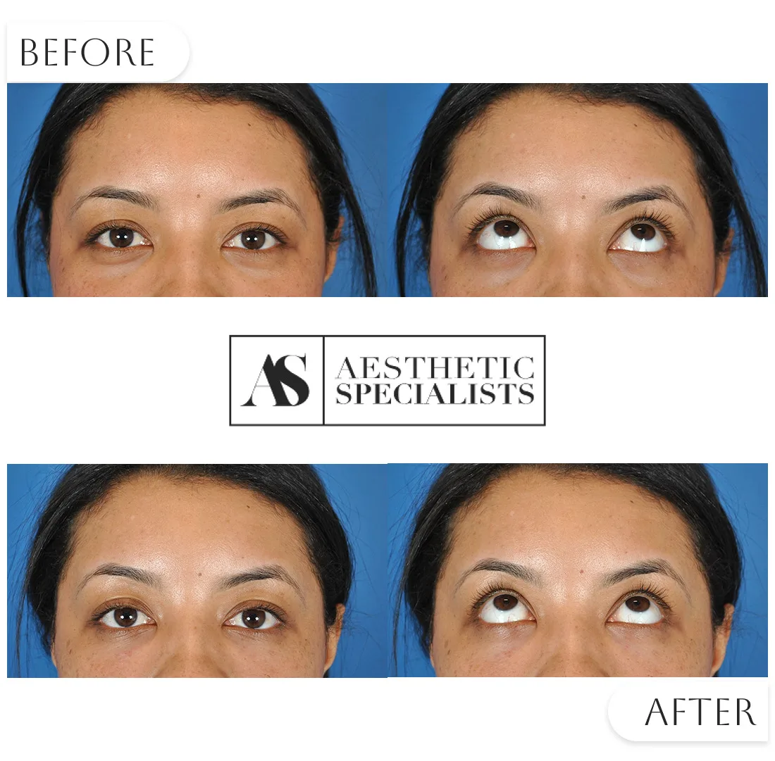 Tear trough filler before and after under-eye rejuvenation | Medical Spa | Bellaire, TX | Aesthetic Specialists of Houston