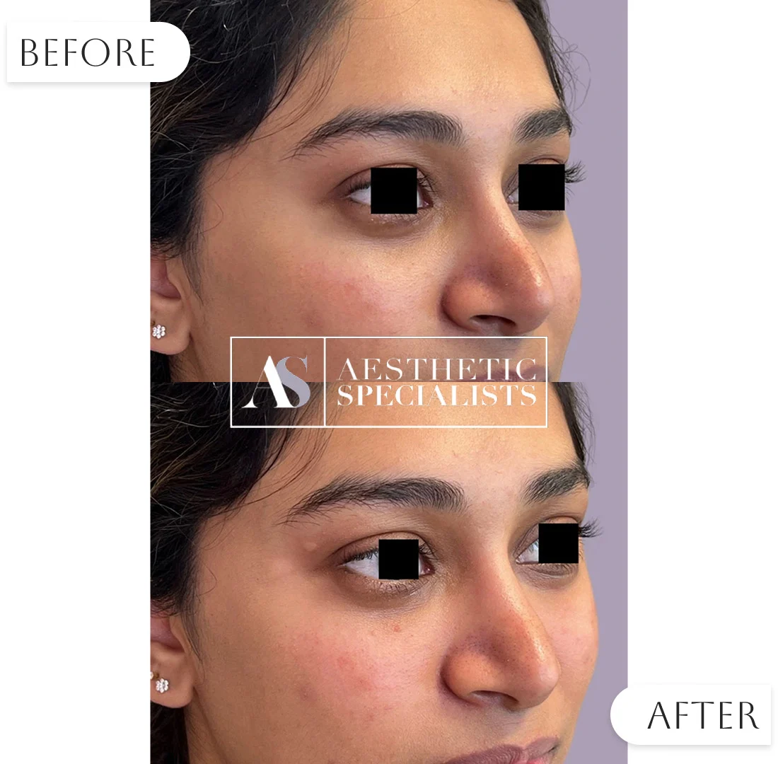 Tear trough filler treatment on client under eyes | Medical Spa | Bellaire, TX | Aesthetic Specialists of Houston